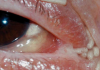 Това е окото на жената заразена с ларви от муха.