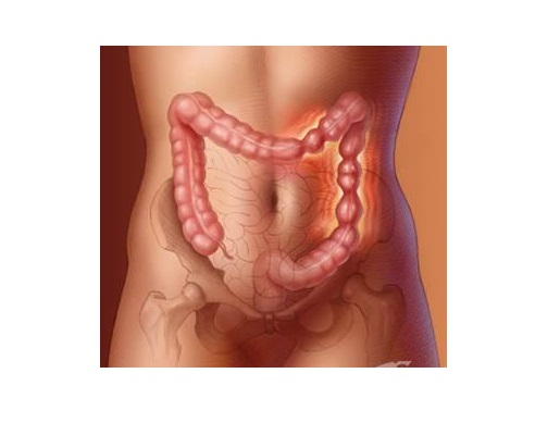синдрома на раздразненото дебело черво